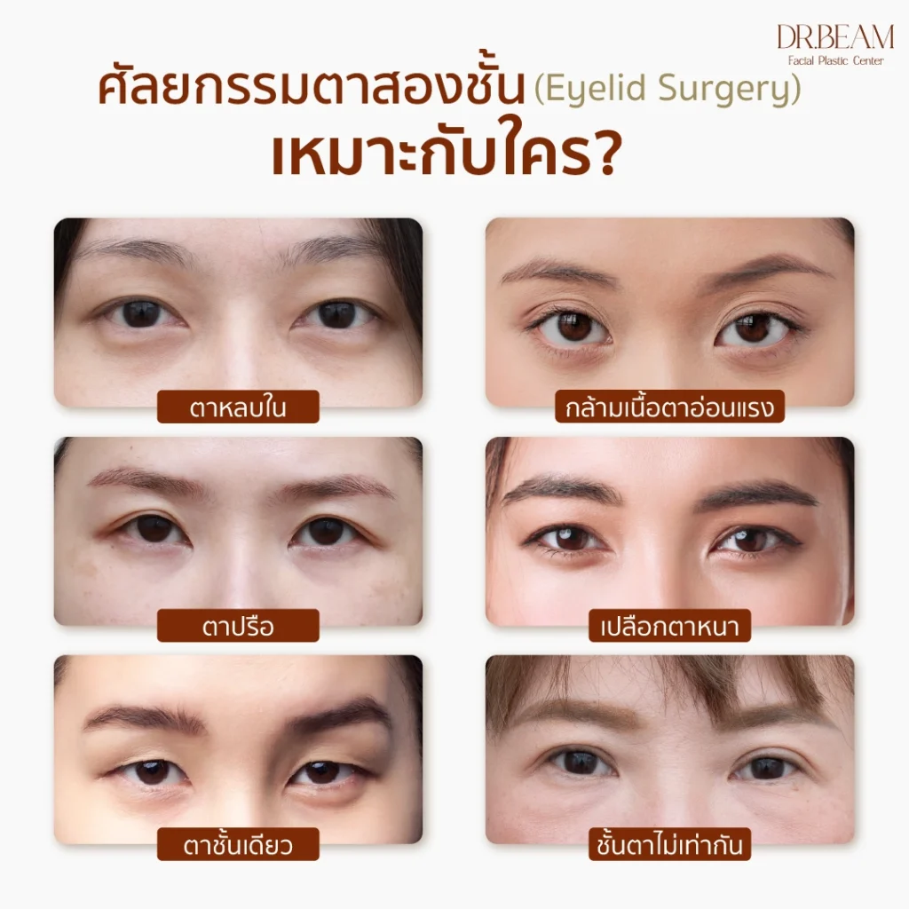 การทำตาสองชั้น เหมาะกับใคร