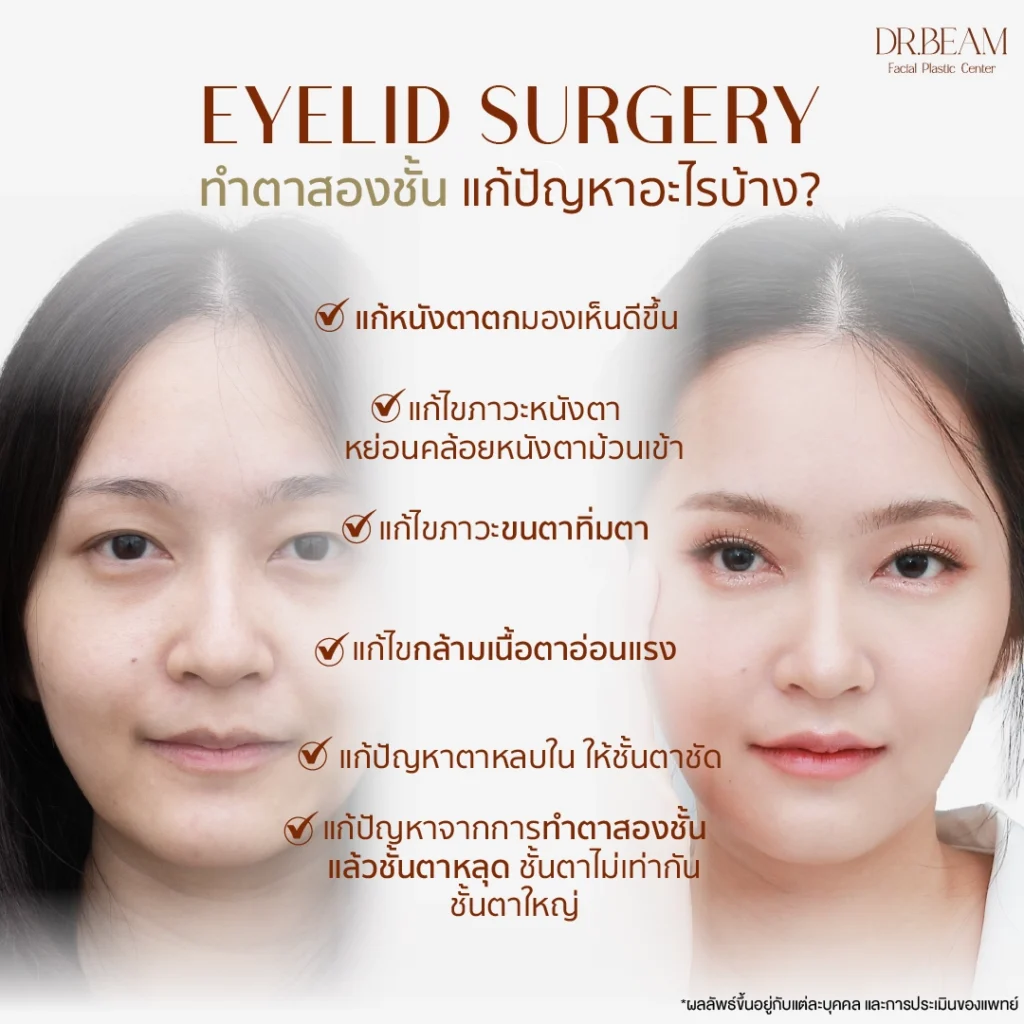 การทำตาสองชั้น แก้ปัญหาอะไรได้บ้าง