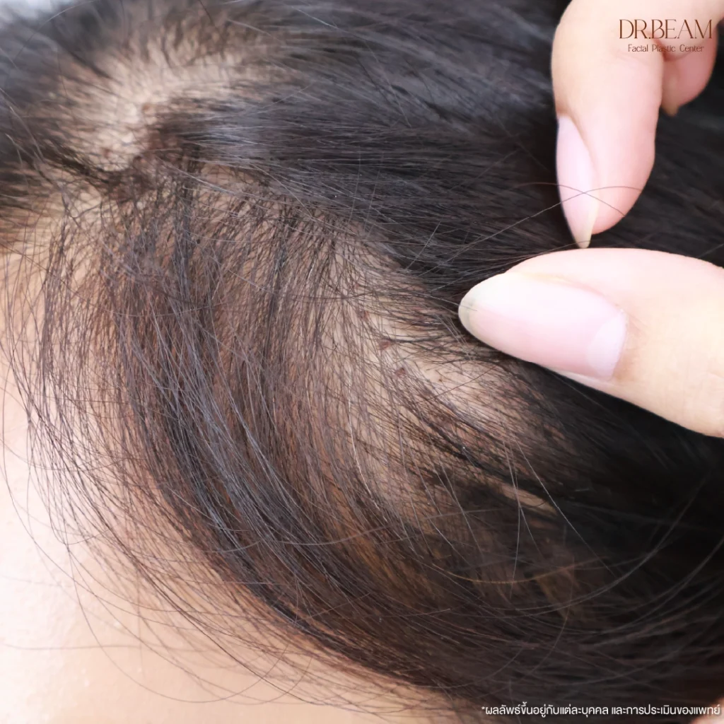 การผ่าตัดยกคิ้ว Endobrow Lift ใช้วิธีส่องกล้องยกคิ้ว