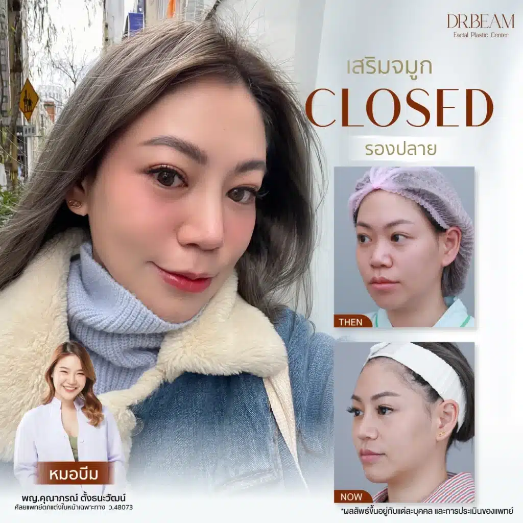 การเสริมจมูกเทคนิค Closed 