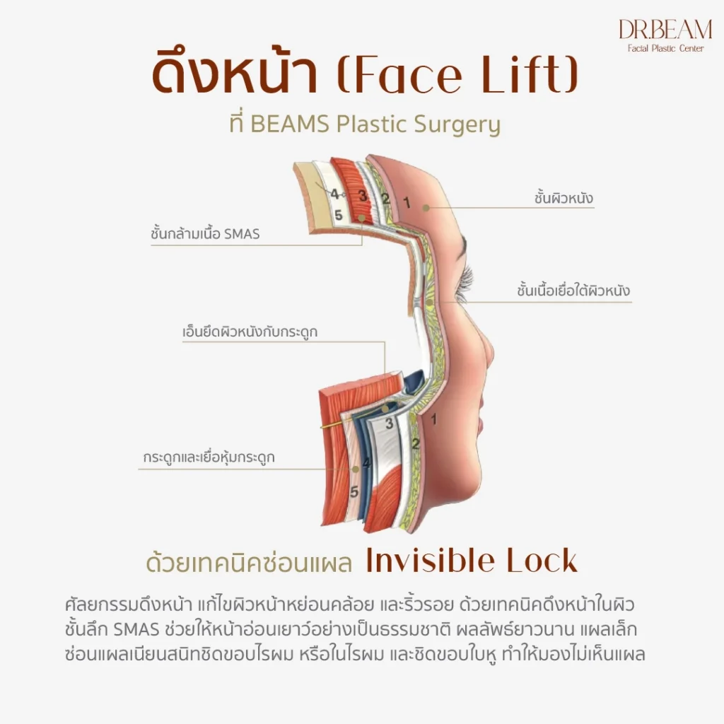 ข้อดีของการดึงหน้า ซ่อนแผลเนียน ด้วยเทคนิค Invisible Lock