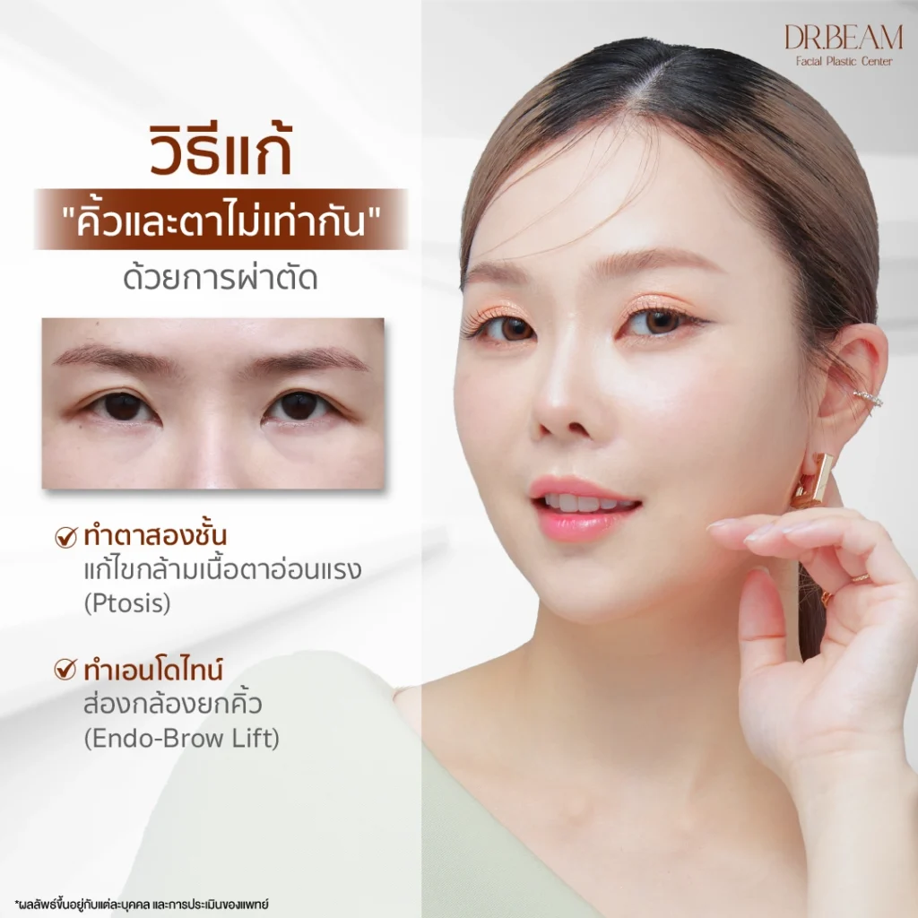 คิ้วและตาไม่เท่ากัน วิธีแก้แบบผ่าตัด Endo-Brow Lift ส่องกล้องยกคิ้ว (Endoscopic brow lift)