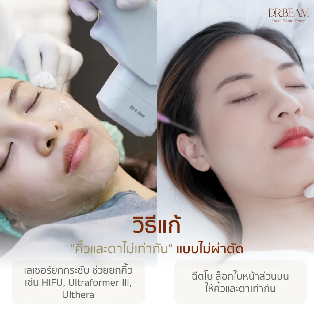 คิ้วและตาไม่เท่ากัน วิธีแก้แบบไม่ผ่าตัด