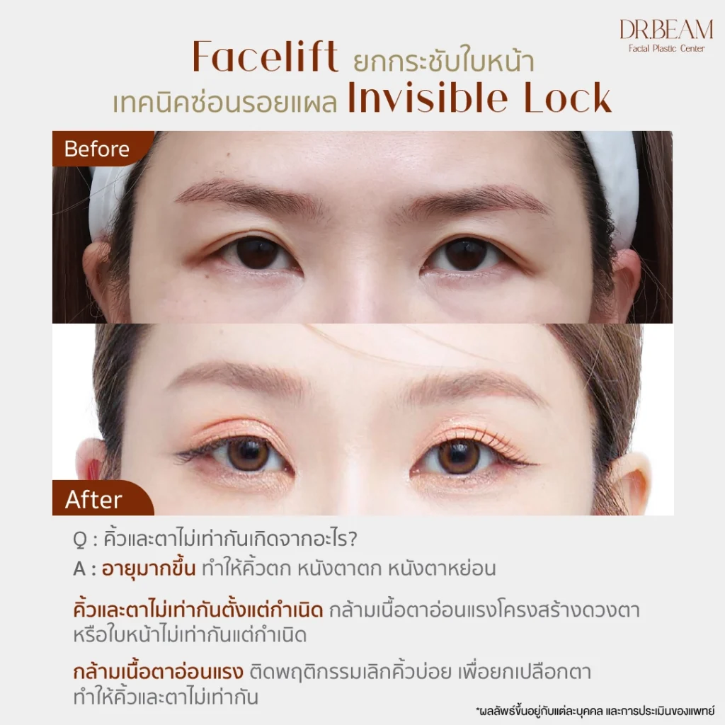 คิ้วและตาไม่เท่ากันเกิดจากอะไร