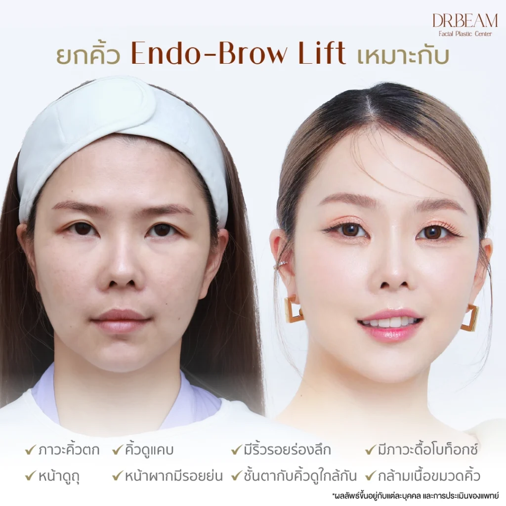 ปัญหาคิ้วและตา ที่เอนโดไทน์ (Endotine) แก้ไขได้