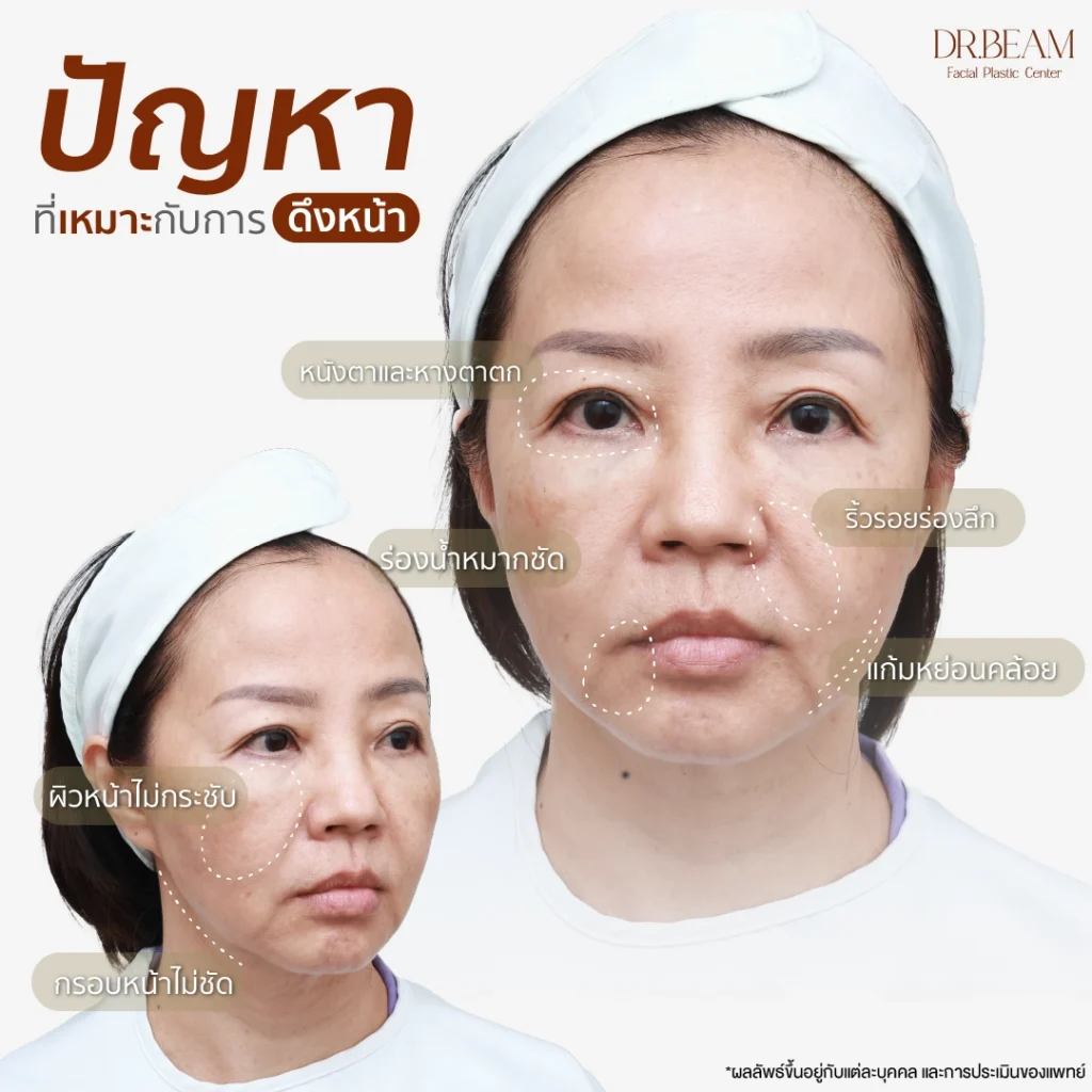 ปัญหาที่เหมาะกับการดึงหน้า