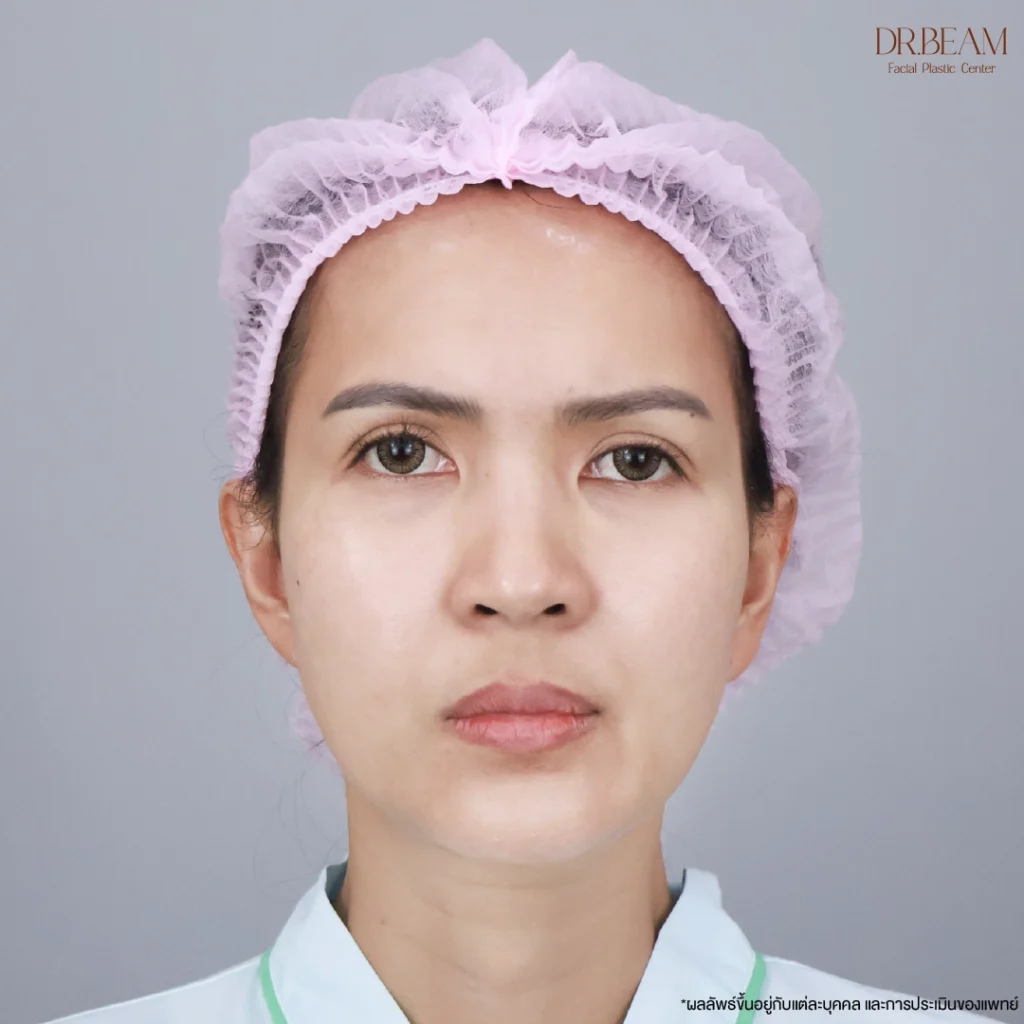 พี่จ๋าปีนี้อายุ 42 ปีแล้ว เข้ามาพบหมอด้วยปัญหาดื้อโบท็อกซ์ 
