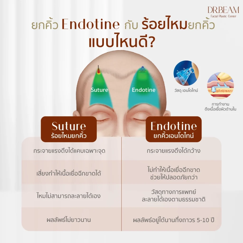 ยกคิ้ว Endotine vs ร้อยไหม