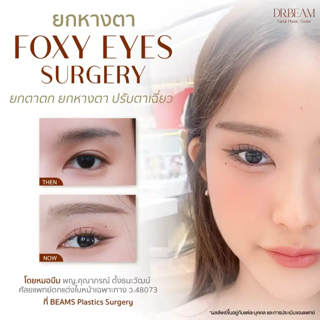หางตาตก แก้ยังไง? ยกหางตา ด้วย Foxy Eyes แก้ตรงจุดหรือไม่?