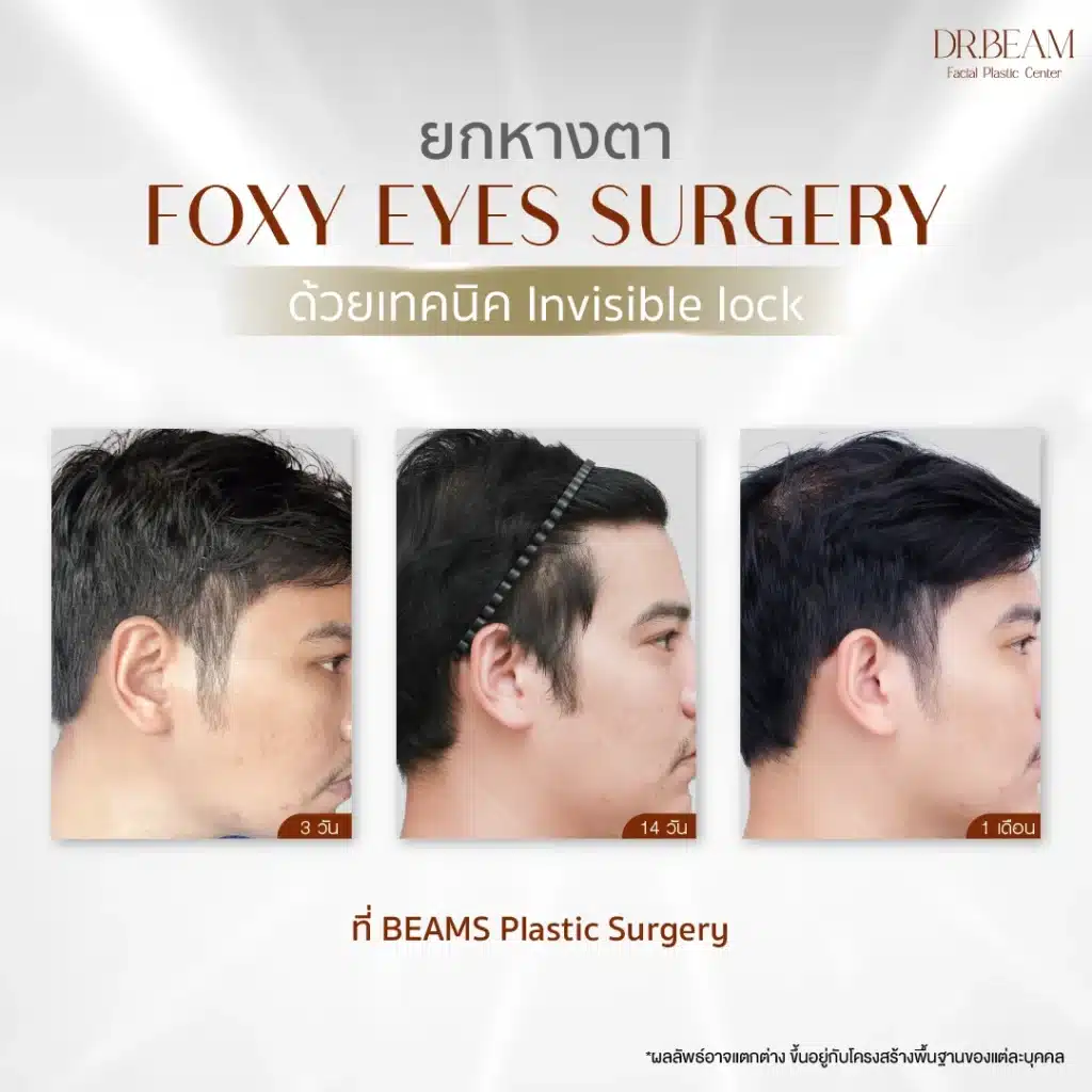 หลังยกหางตา Foxy Eyes ด้วยเทคนิค Invisible lock 