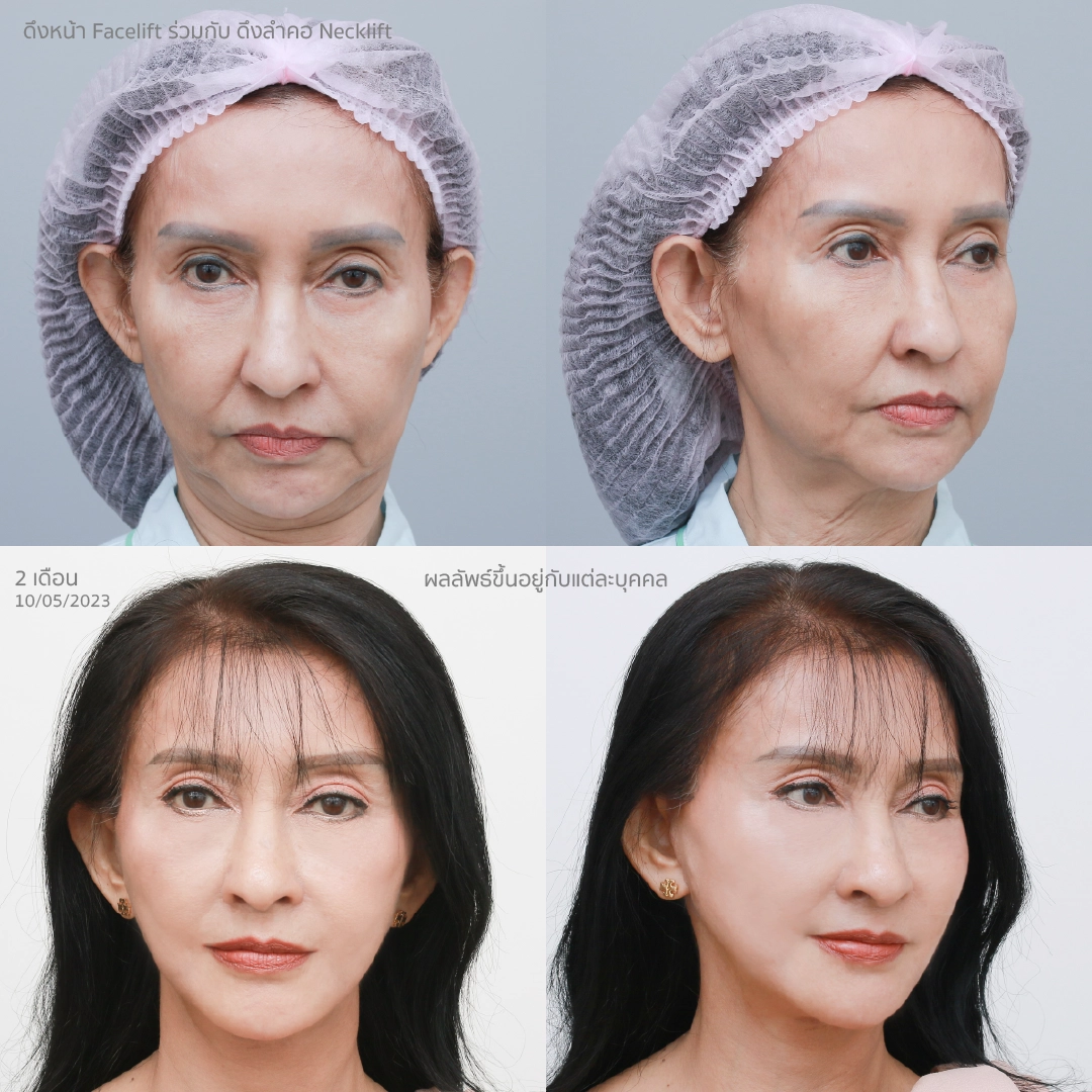รวมรูปคุณปู ผลลัพธ์ ก่อนทำ-หลังทำ