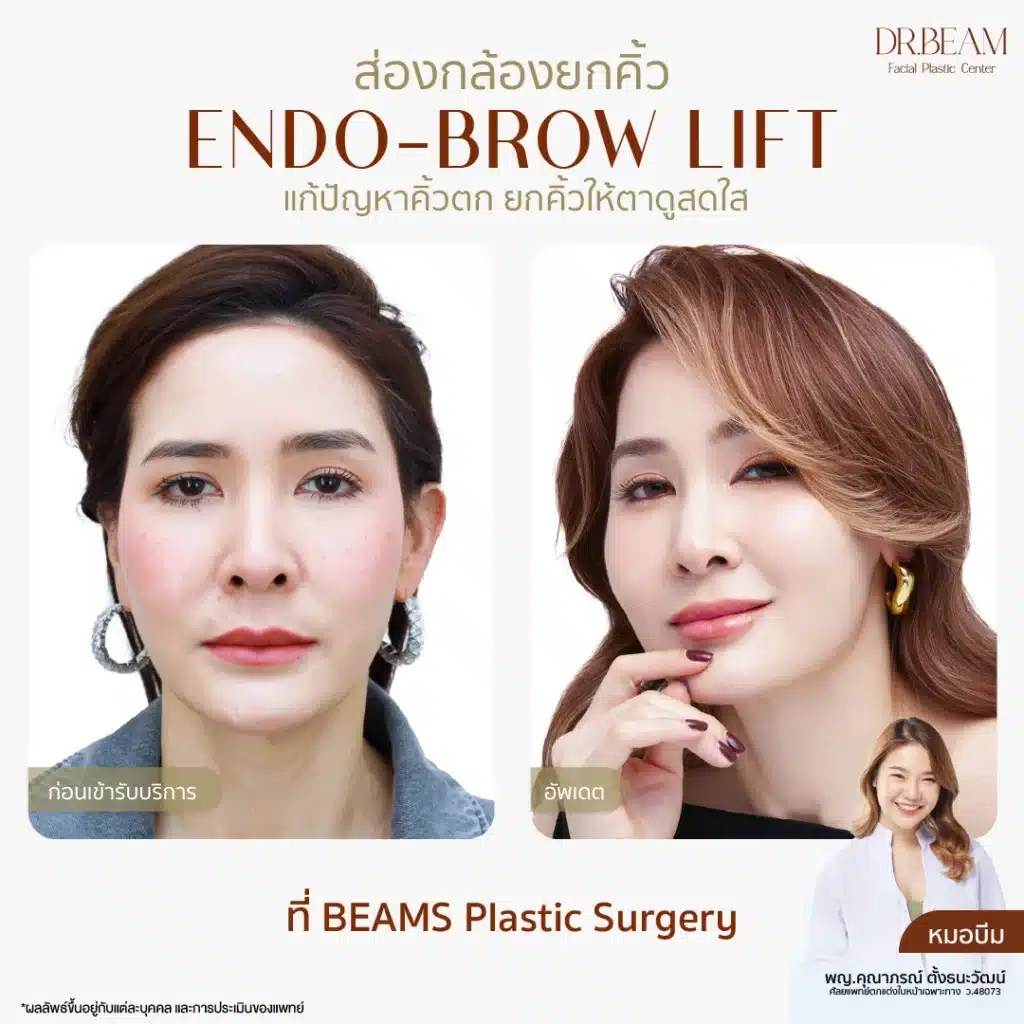 Endo-Brow Lift แก้คิ้วตก ยกคิ้วให้ตาดูสดใสขึ้น