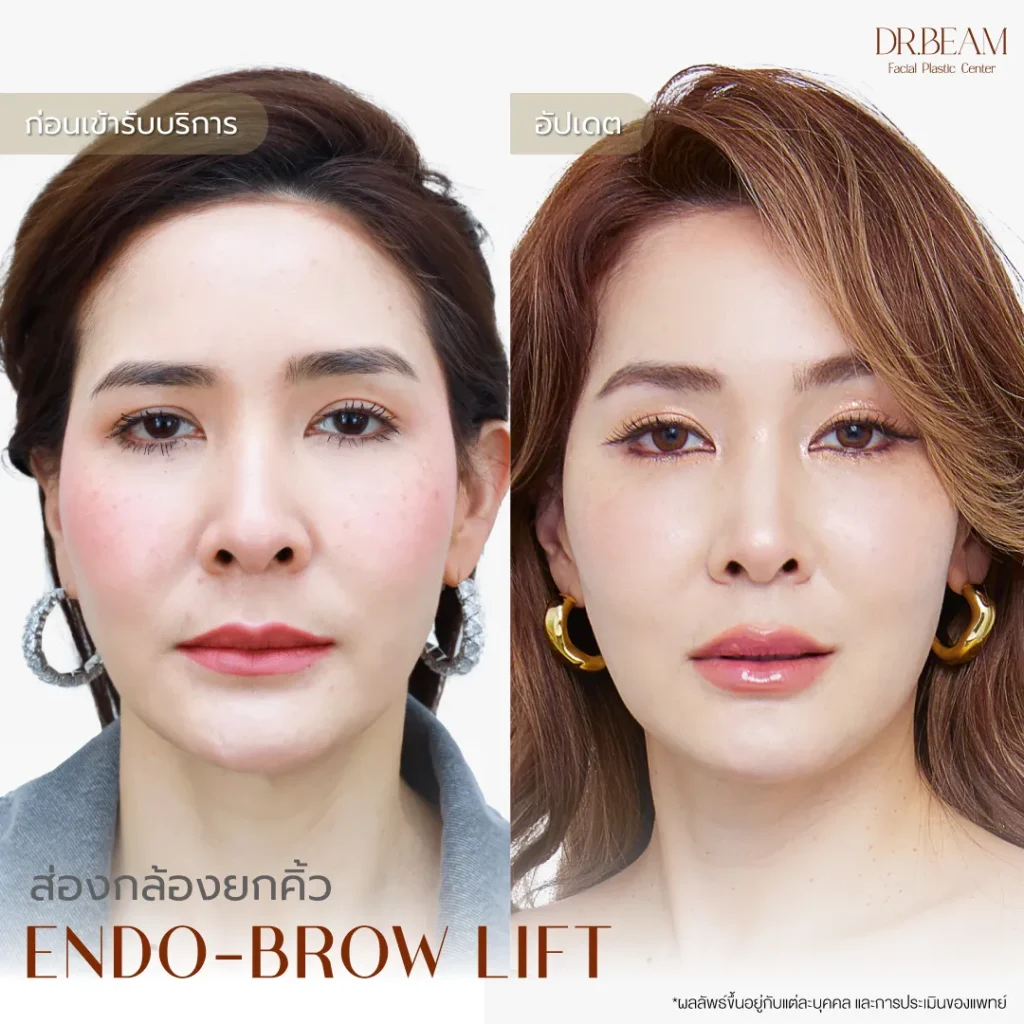 รีวิวยกคิ้วเอนโดไทน์ (Endo-Brow Lift) กับ หมอบีม Endotine ที่ BLS Surgery Center