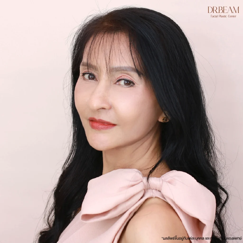 หลังผ่าตัดดึงหน้า และยกกระชับลำคอ 3 เดือน