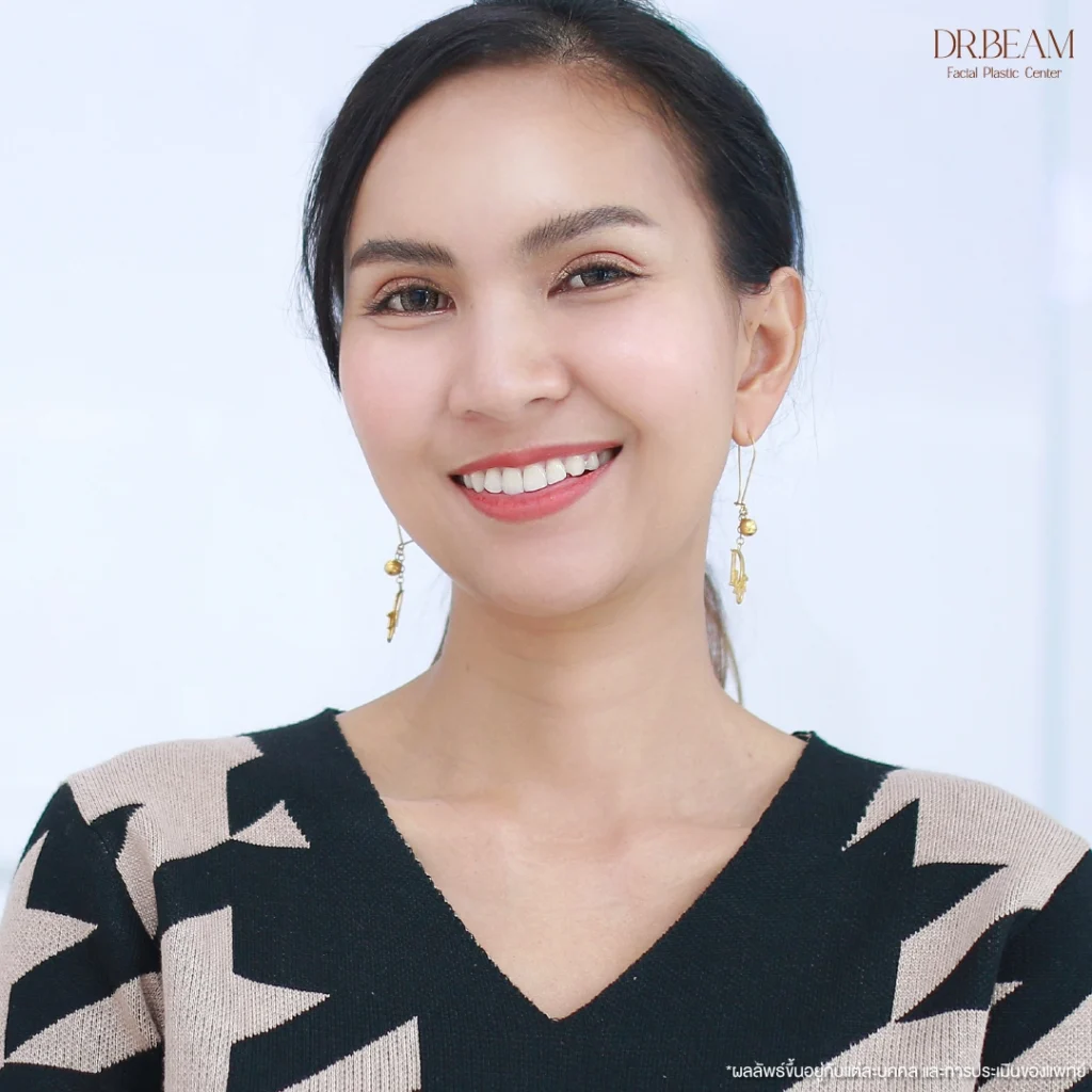 หลังจากผ่านไป 1 เดือน ผลลัพธ์ของพี่จ๋าดูเป็นธรรมชาติมากๆ