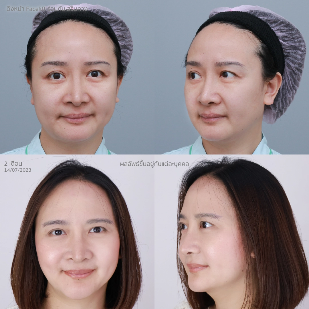 คสรีวิวคุณแอนผลลัพธ์ก่อนทำ-หลังทำ