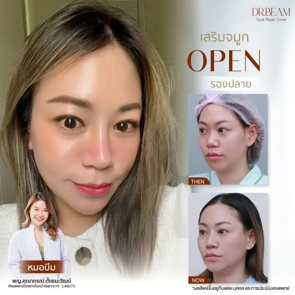 เสริมจมูก แบบโอเพ่น ร่วมกับการตัดปีกจมูก
