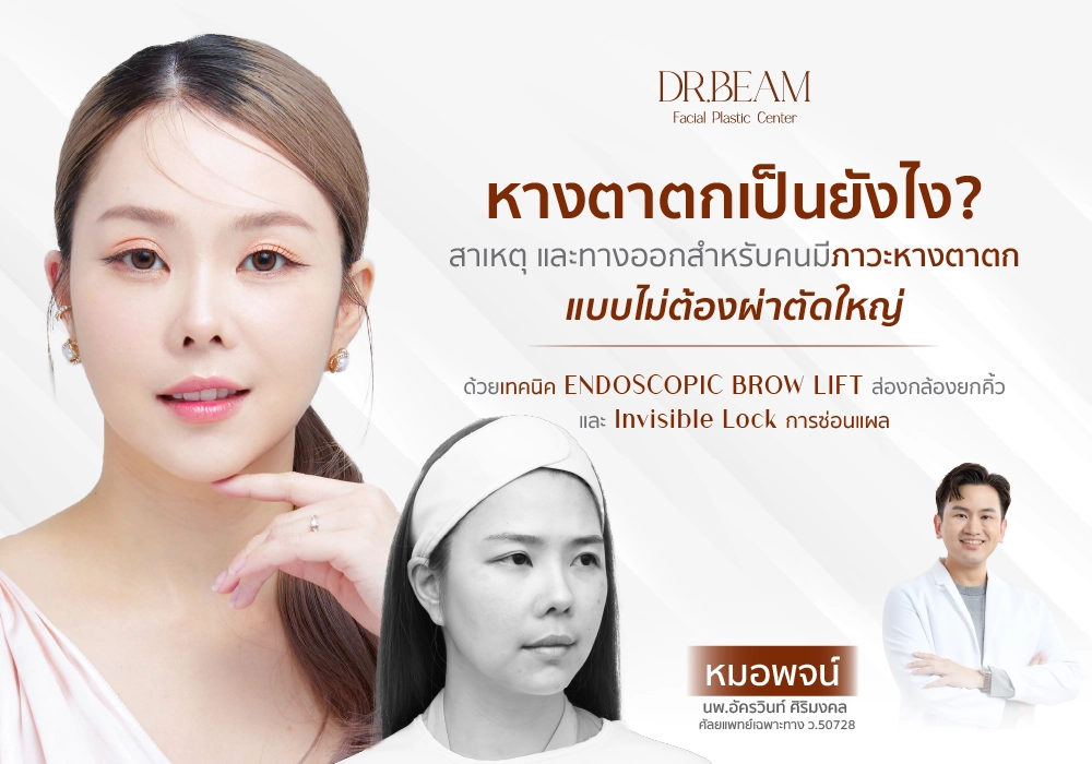 หางตาตกเป็นยังไง แก้ด้วยแบบไม่ต้องผ่าตัดใหญ่