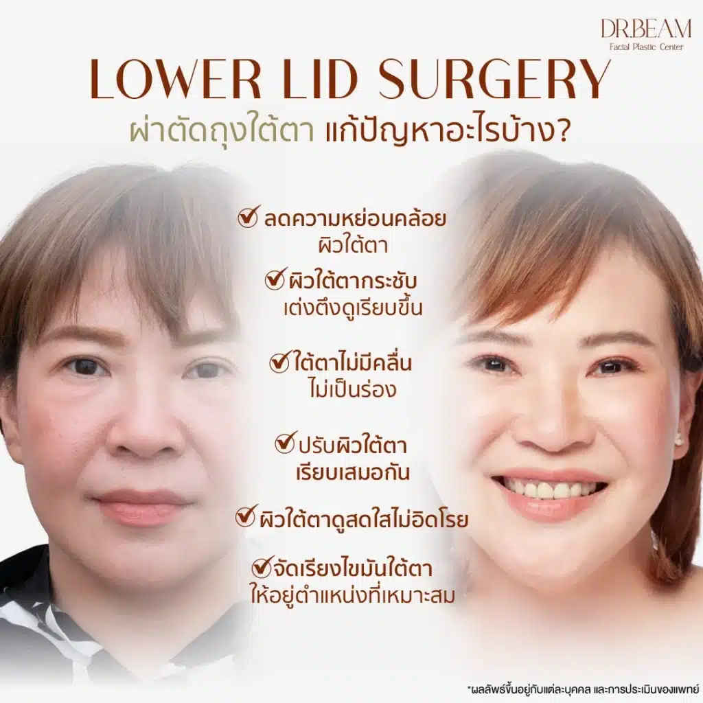 ปัญหาที่เหมาะกับการผ่าตัดถุงใต้ตา | ผ่าตัดถุงใต้ตา
