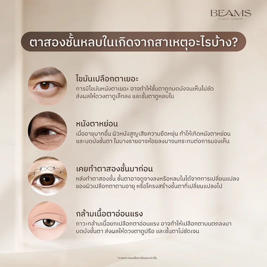 ตาสองชั้นหลบในเกิดจากอะไร