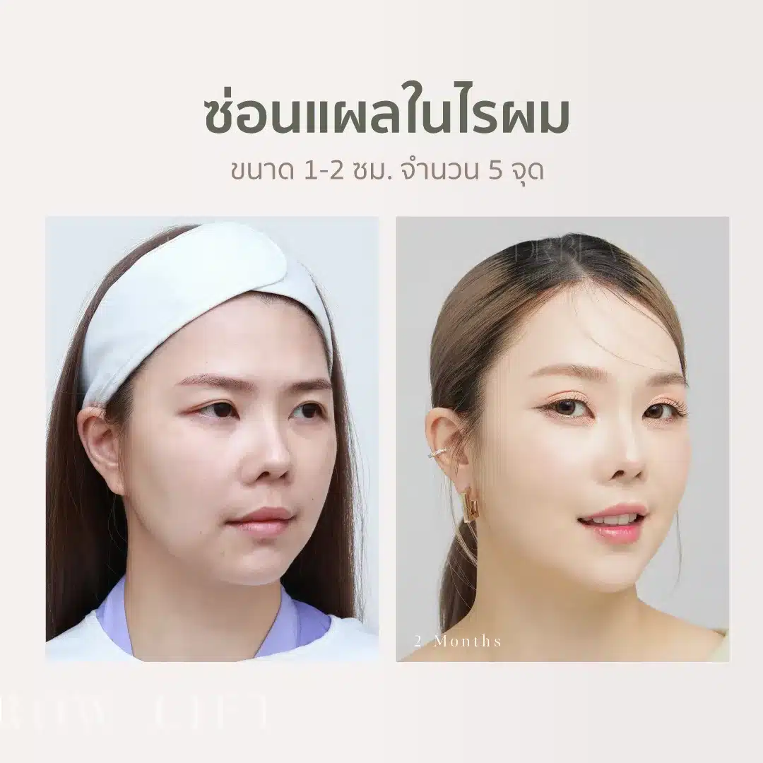 หางตาตก กับวิธีInvisible Lock ซ่อนแผลตามไรผม