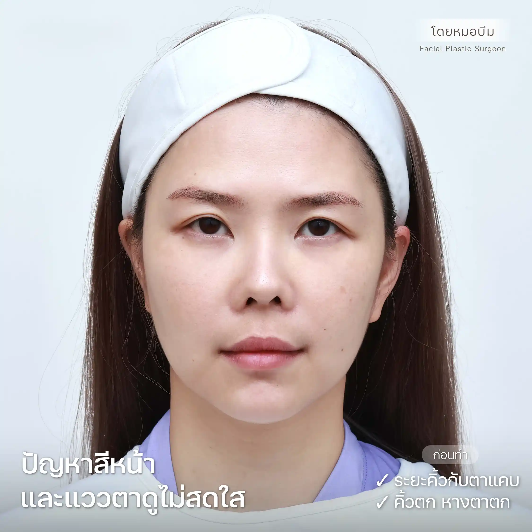 ปัญหาคิ้วตก หางตาตก