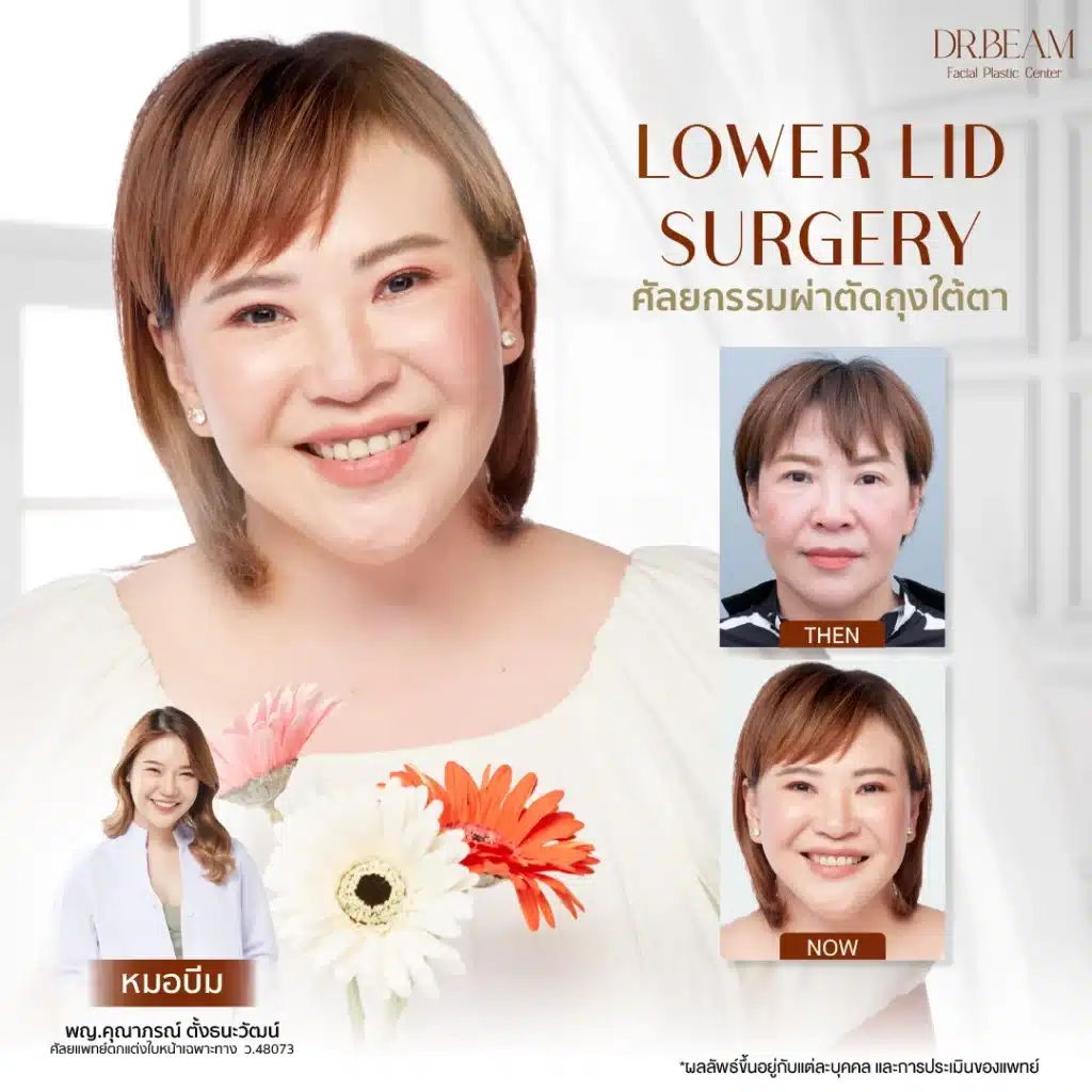 ผ่าตัดถุงใต้ตา พร้อมกับการทำตาสองชั้น (Eyelid Surgery) หรือการผ่าตัดดึงหน้า (Facelift)