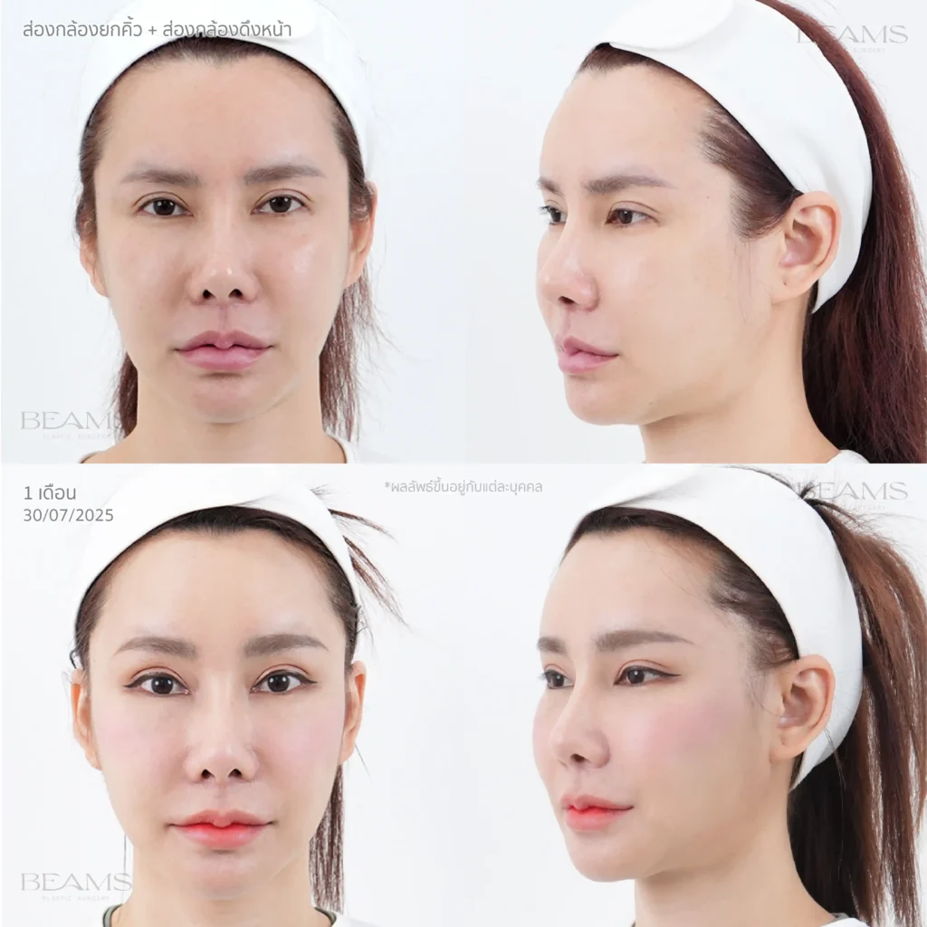 ศัลยกรรมส่องกล้องดึงหน้า (Endo-Face Lift)