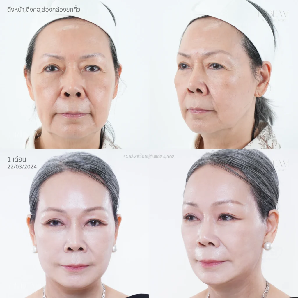 ศัลยกรรมผ่าตัดดึงหน้า (Facelift)