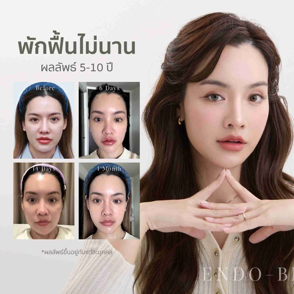 หางตาตก แก้ด้วยยกคิ้ว Endoscopic Brow lift