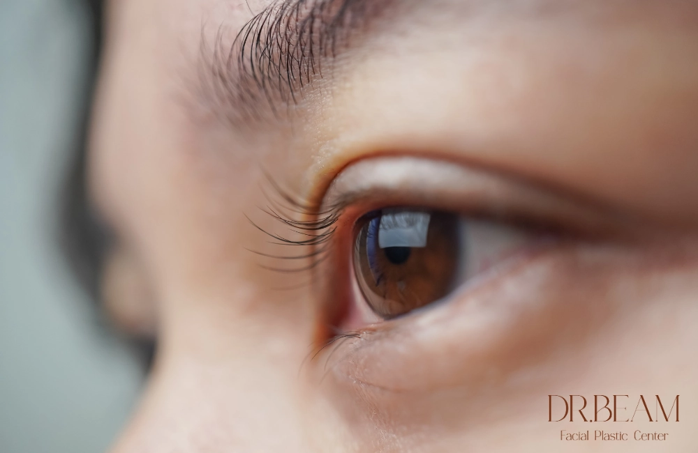 ปัญหาถุงใต้ตา