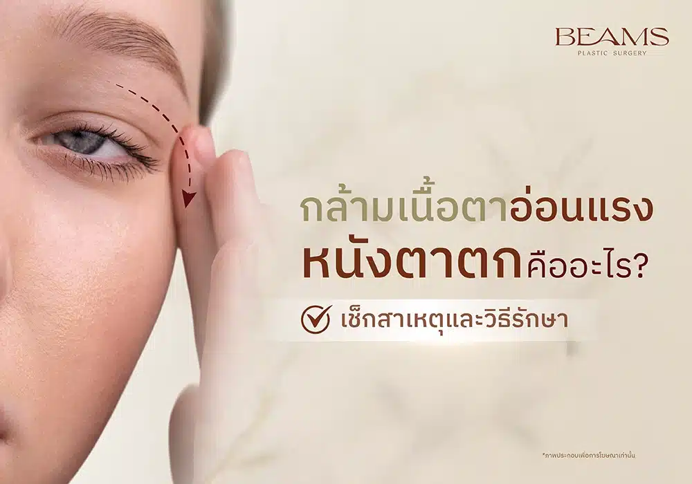 กล้ามเนื้อตาอ่อนแรง
