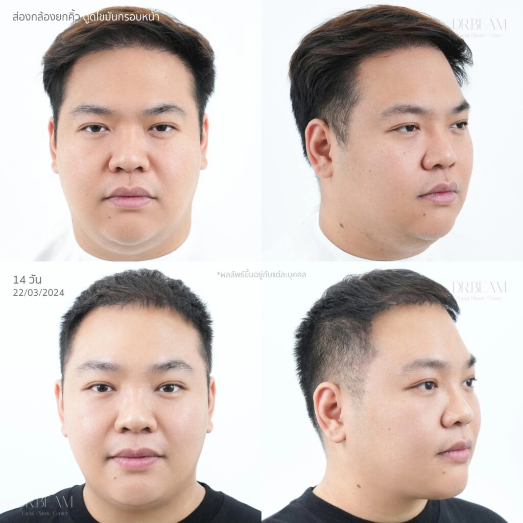 Review Endo-Brow Lift