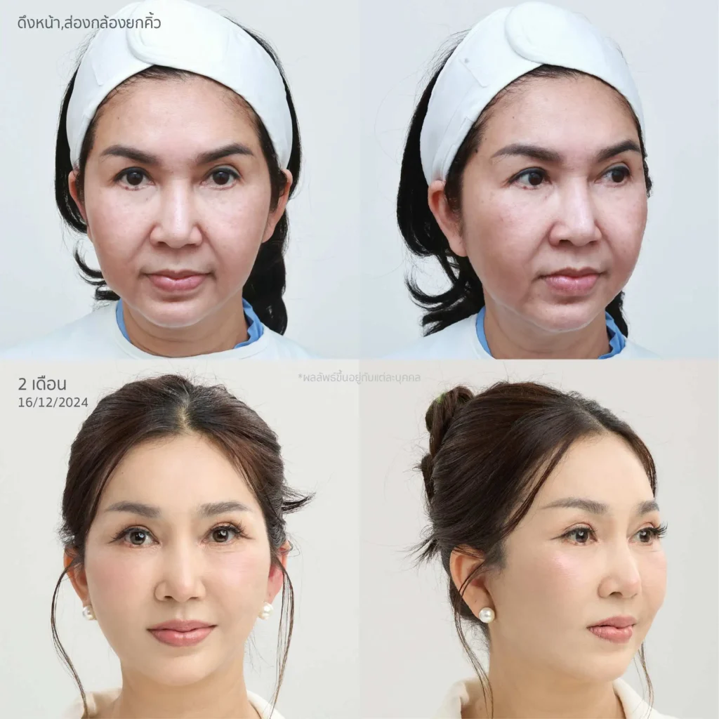 ภาพก่อน-หลังดึงหน้า Invisible Lock ที่ BEAMS Plastic Surgery