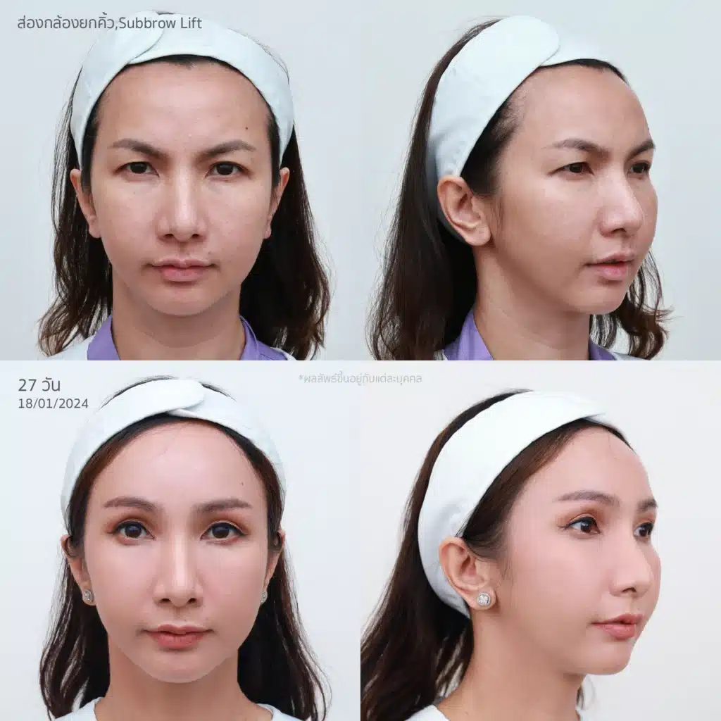 “Endo Browlift คือ ใครเหมาะกับ Endo Browlift