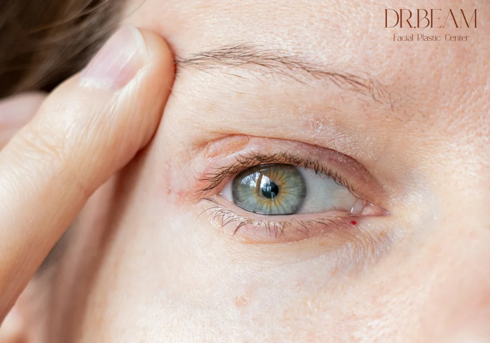 ไขมันเปลือกตาคืออะไร