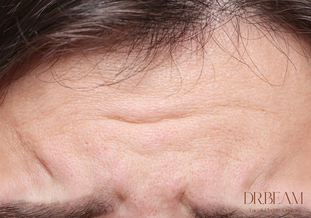 วิธีลดริ้วรอยหน้าผาก