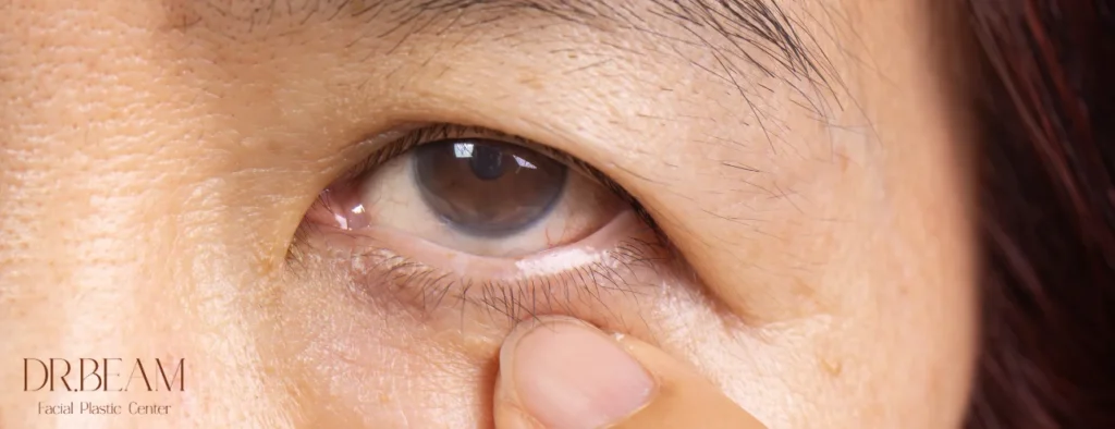 หนังตาเหี่ยวแก้ไขอย่างไร