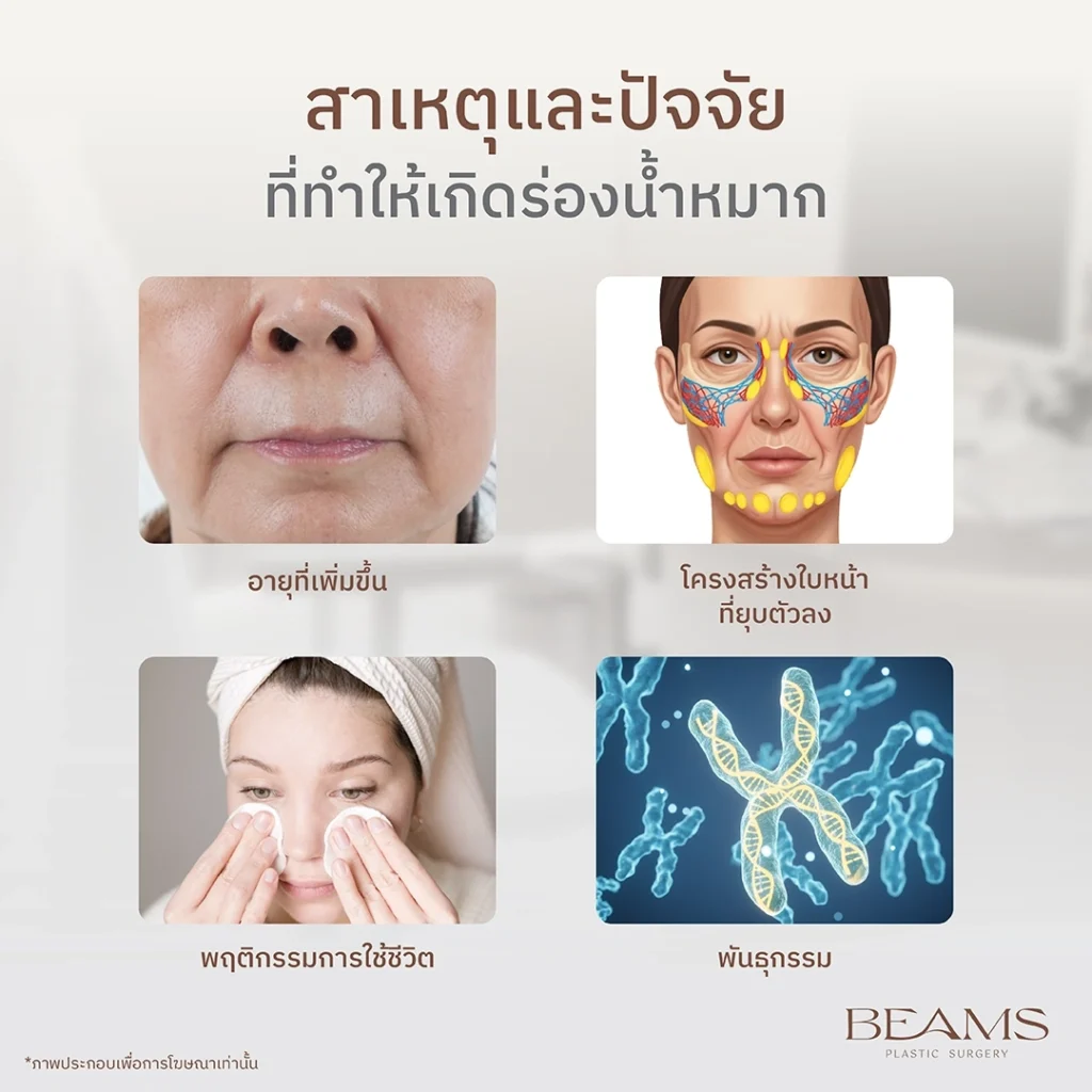 สาเหตุของร่องน้ำหมาก