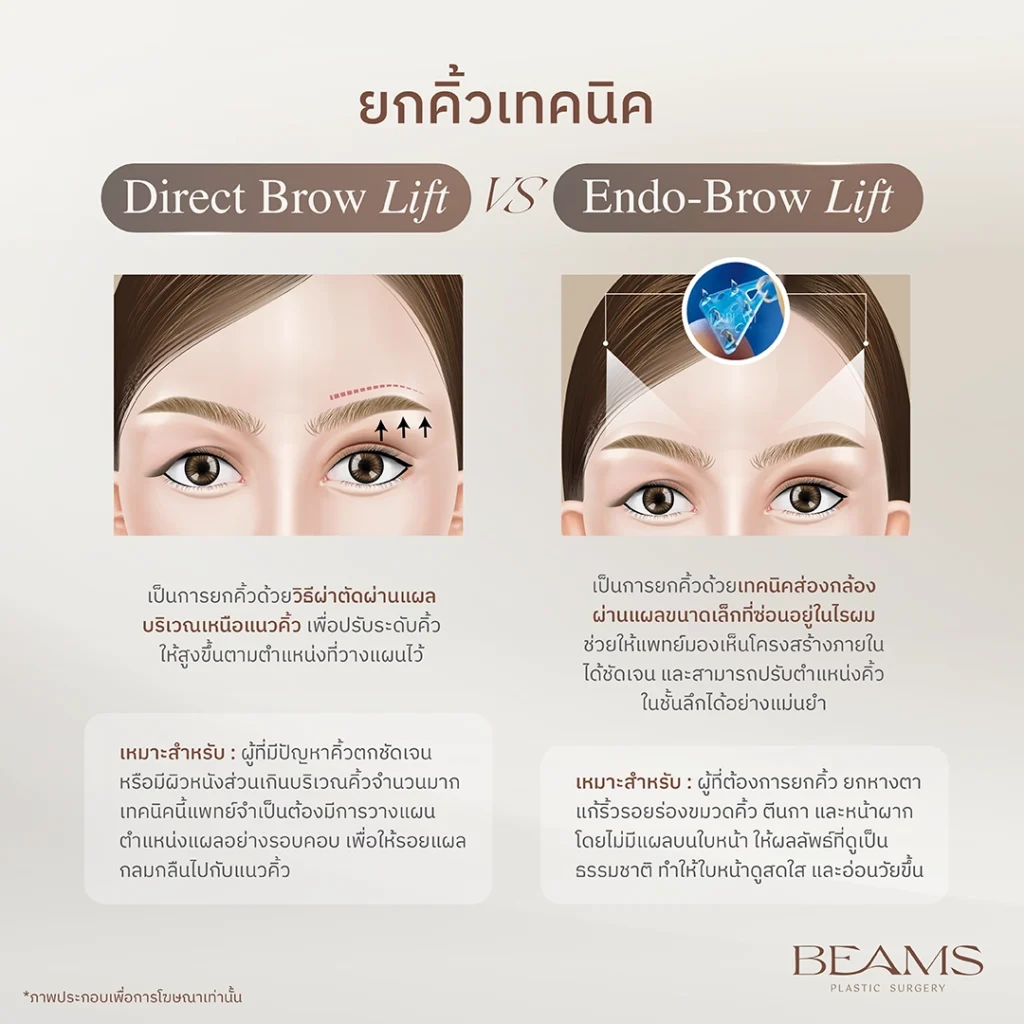 direct brow lift vs endo brow lift