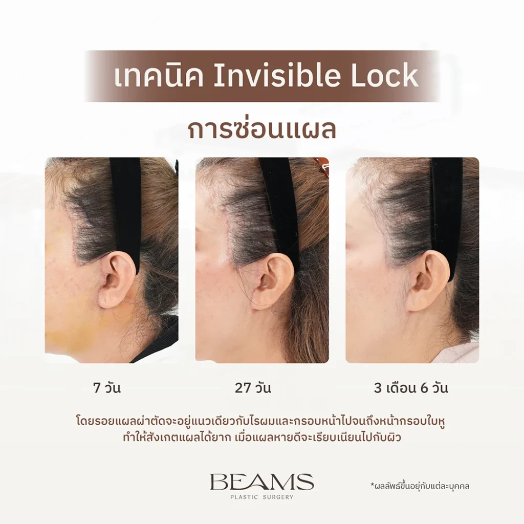 รีวิวดึงหน้า เทคนิค Invisible Lock การซ่อนแผล