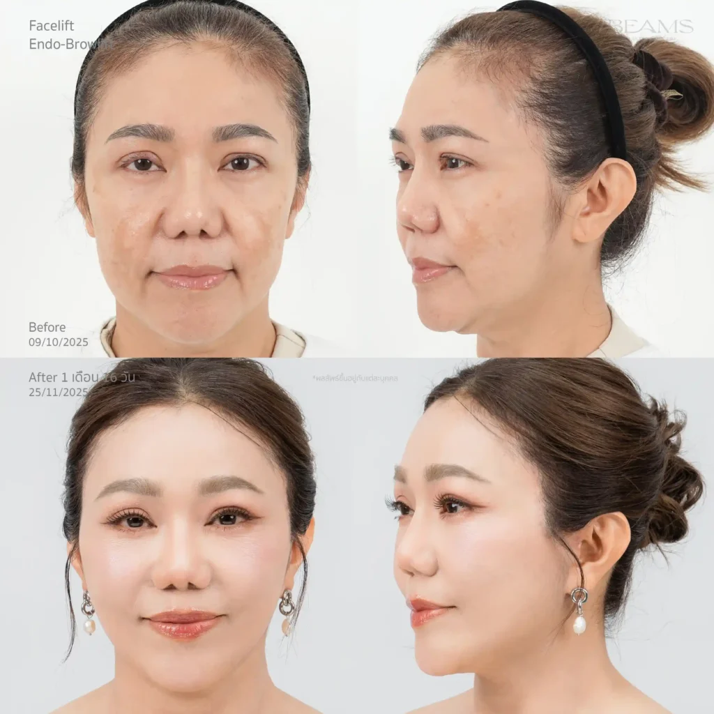 Facelift รีวิว