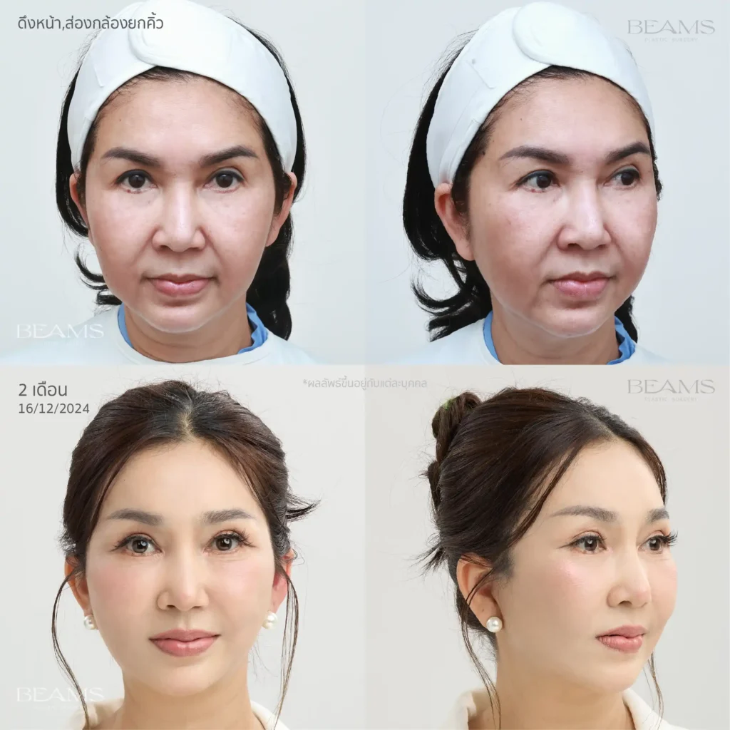 รีวิวดึงหน้าในผู้หญิง