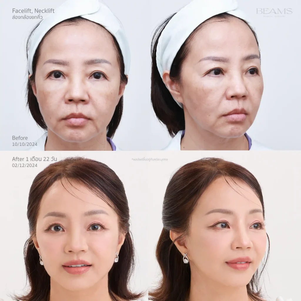 เคสดึงหน้า