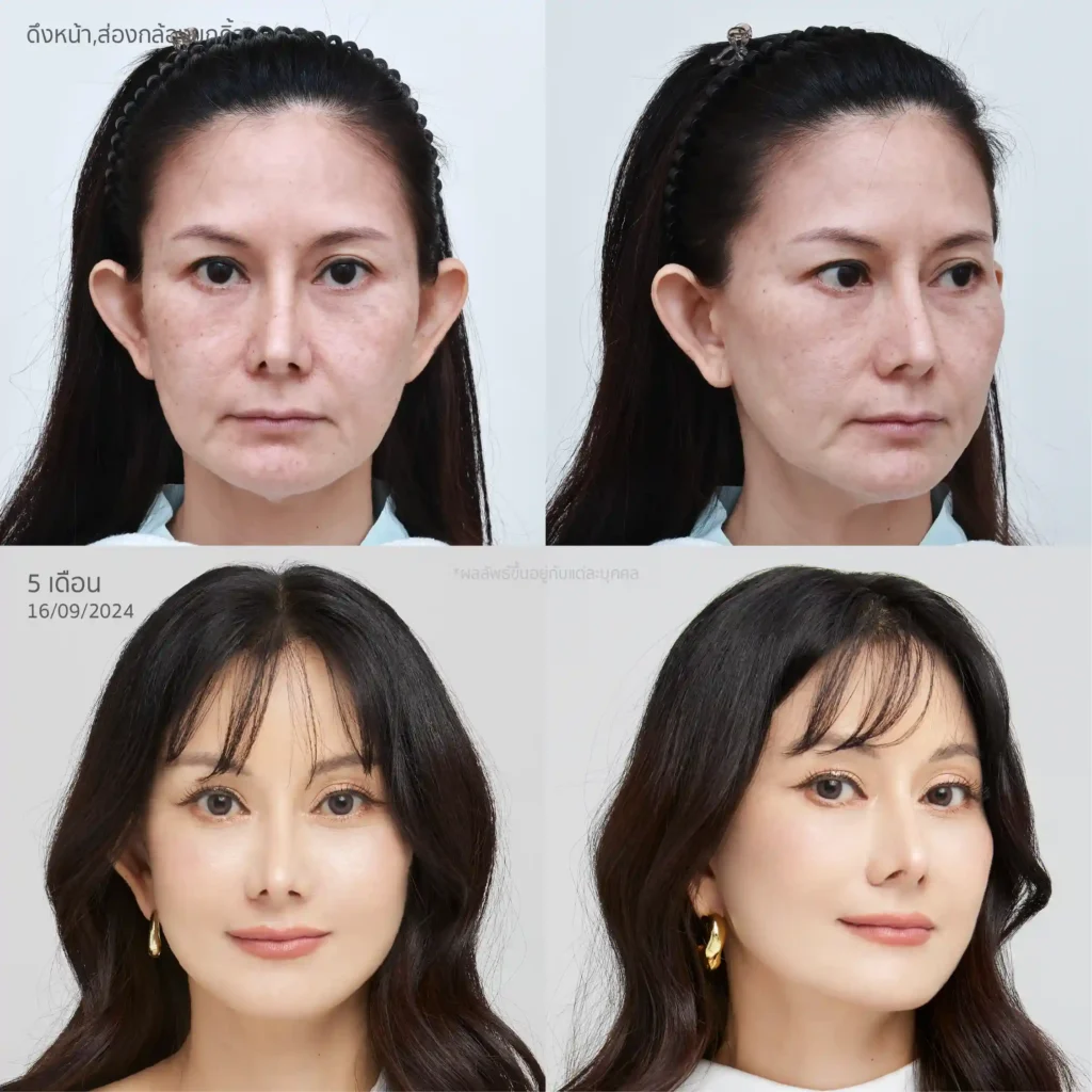 เคสรีวิวดึงหน้ากับหมอบีม