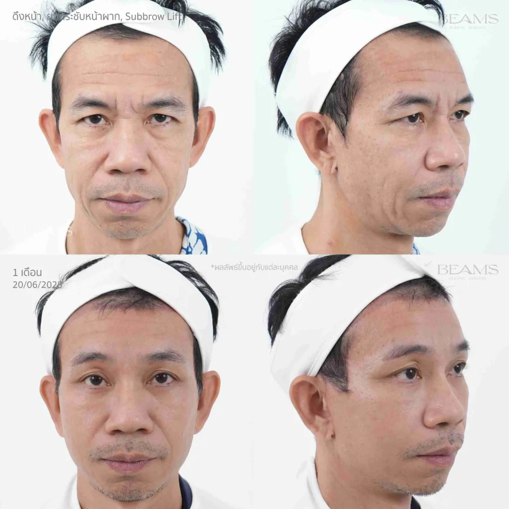 รีวิวดึงหน้ากับหมอบีม