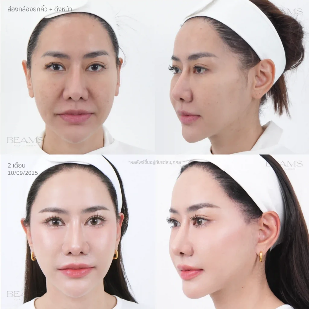 ดึงหน้ากับหมอบีม