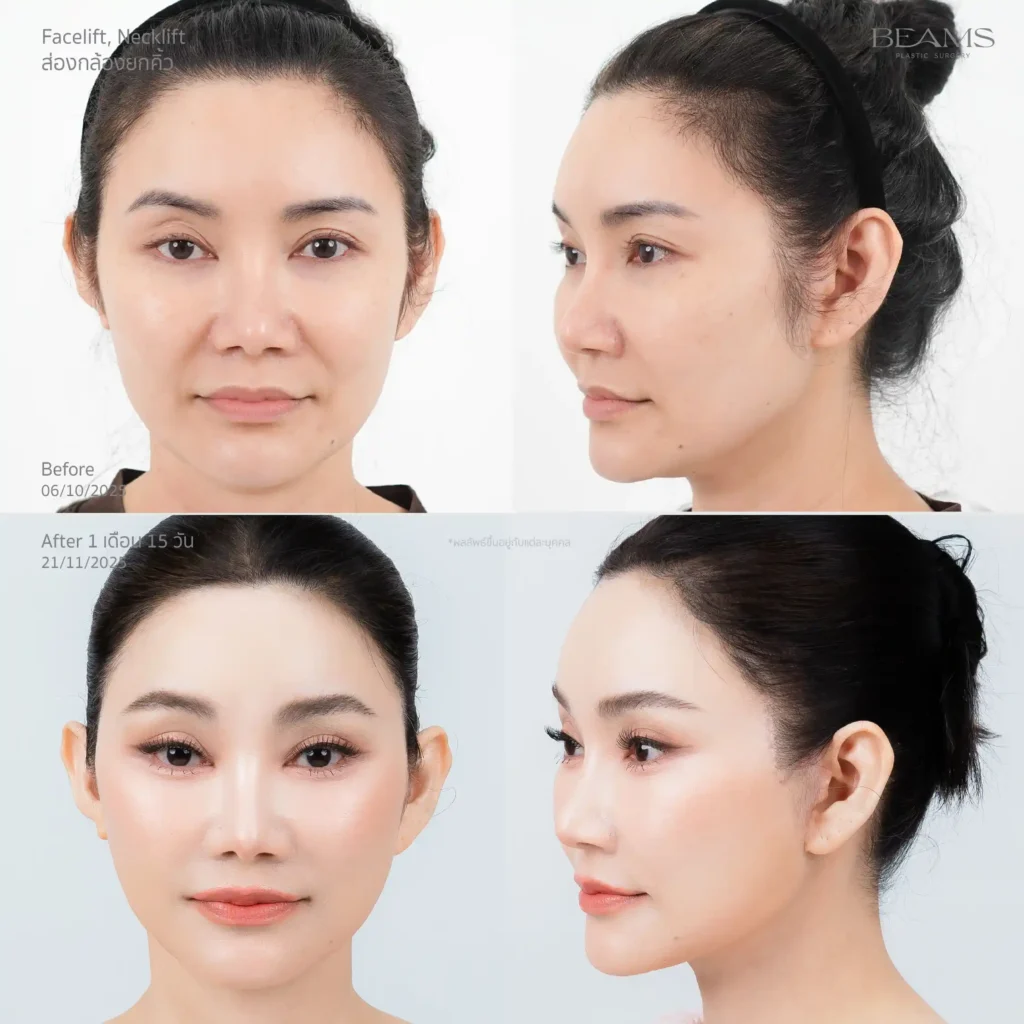 ดึงหน้ารีวิว กับหมอบีม