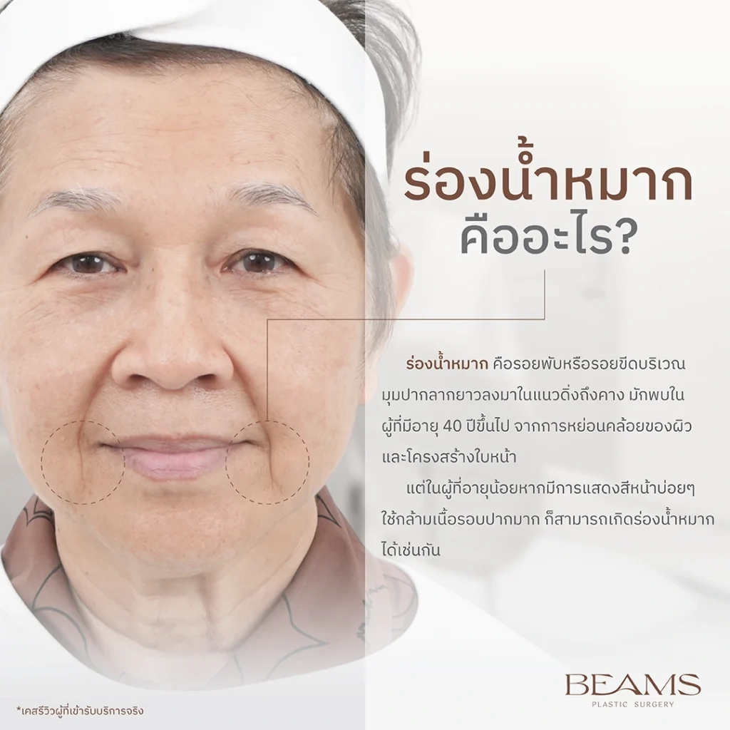 ร่องน้ำหมากคืออะไร