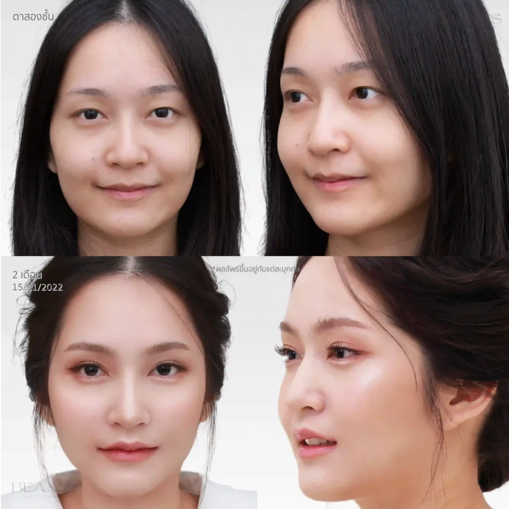 รีวิวทำตาสองชั้น